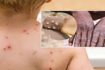 Phân biệt bệnh đậu mùa khỉ và bệnh thủy đậu