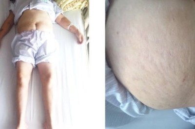 Bé 5 tuổi bị viêm gan cấp, đau khớp vì uống thực phẩm chức năng tăng chiều cao