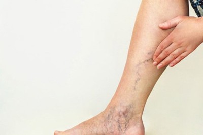 Vì sao phụ nữ hay bị giãn tĩnh mạch chi?