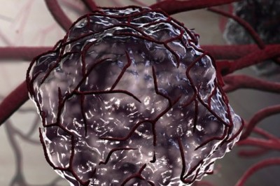 Hóa trị hơn 30 lần mới phát hiện bị chẩn đoán nhầm ung thư