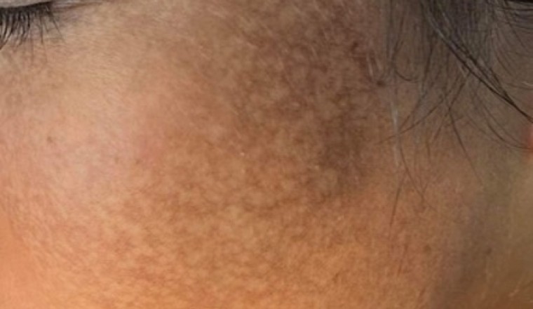 Sau liệu trình chăm sóc da trong vòng một năm tại một spa cô gái nhận được kết quả khủng kiếp