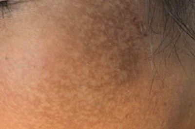 Sau liệu trình chăm sóc da trong vòng một năm tại một spa cô gái nhận được kết quả khủng kiếp