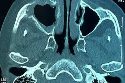 Tìm nguyên nhân nhiều người hoại tử sọ, hàm mặt sau mắc Covid