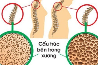 5 cây thuốc nam, cây thảo dược hỗ trợ ngăn ngừa loãng xương