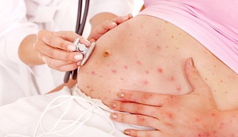 Thai phụ cẩn trọng không để mắc đậu mùa khỉ