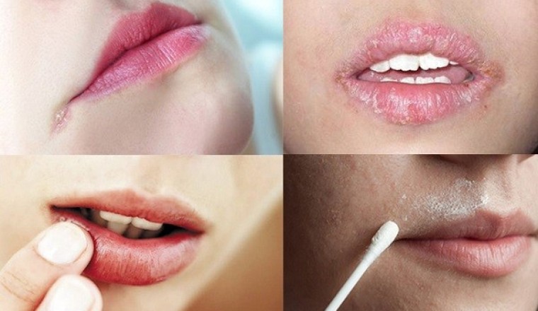 Bệnh chốc mép chữa thế nào?