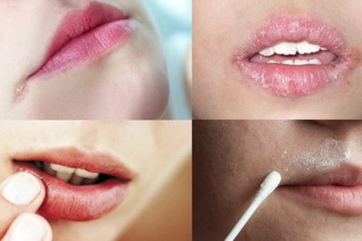 Bệnh chốc mép chữa thế nào?