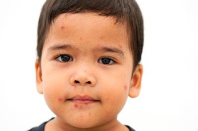 Bệnh cúm cà chua: Dịch cúm mới nổi tại Ấn Độ nguy hiểm thế nào