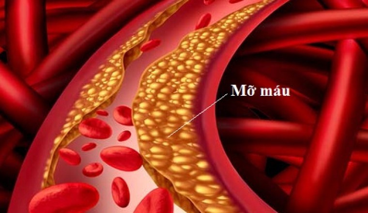 'Một nửa người Việt ở thành phố bị mỡ máu cao'