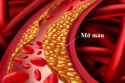 'Một nửa người Việt ở thành phố bị mỡ máu cao'