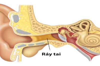 Tác dụng ít người biết của ráy tai