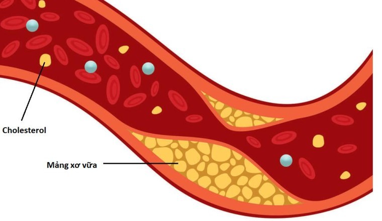 10 bài thuốc nam cực hiệu quả trị tăng mỡ máu (cholesterol)