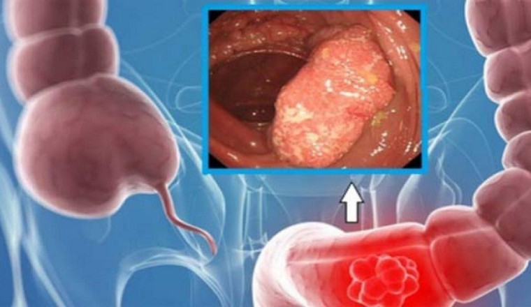 3 dấu hiệu ung thư ruột đã di căn vào xương