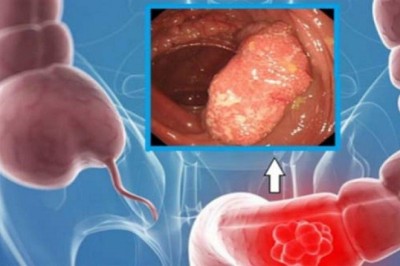 3 dấu hiệu ung thư ruột đã di căn vào xương