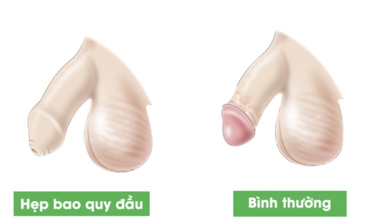 Bộ Y tế yêu cầu báo cáo vụ tai biến nặng sau cắt bao quy đầu