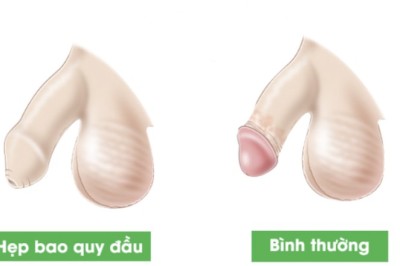 Bộ Y tế yêu cầu báo cáo vụ tai biến nặng sau cắt bao quy đầu