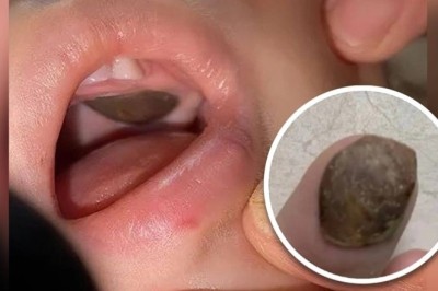 Bé trai mắc vỏ hạt sen trong miệng bị chẩn đoán nhầm có khối u