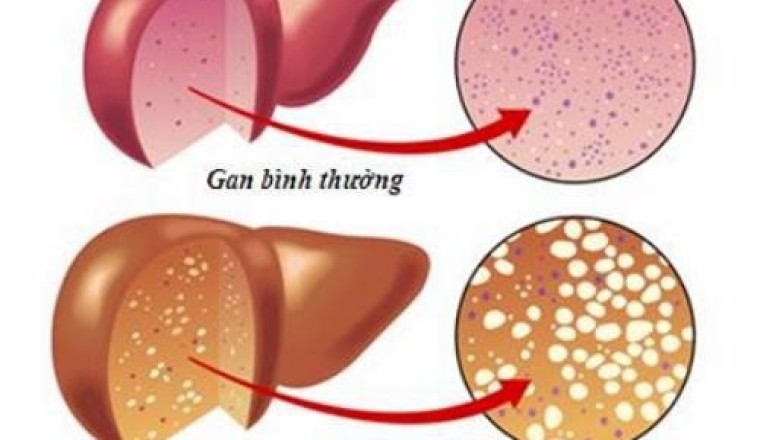 4 bài thuốc nam trị bệnh gan nhiễm mỡ hiệu quả