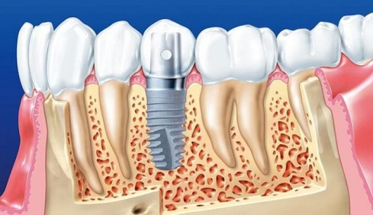 Lịch sử ra đời và phát triển của những chiếc răng giả