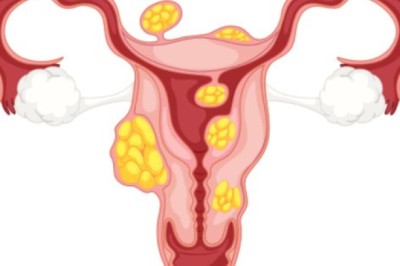 Thuốc mới điều trị u xơ tử cung