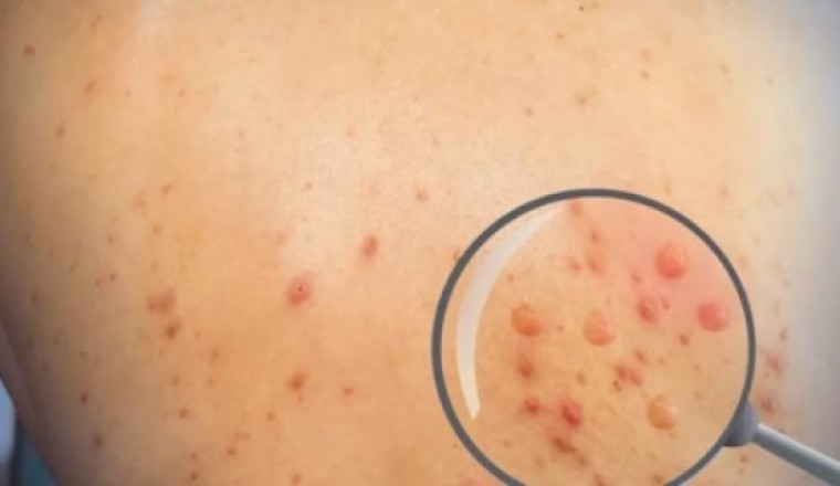 TP.HCM ghi nhận ca đậu mùa khỉ đầu tiên