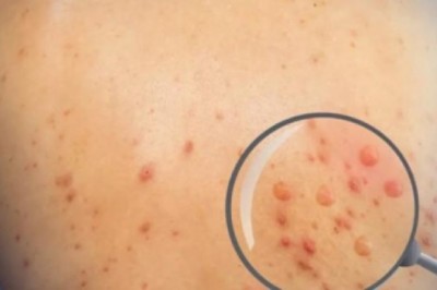 TP.HCM ghi nhận ca đậu mùa khỉ đầu tiên