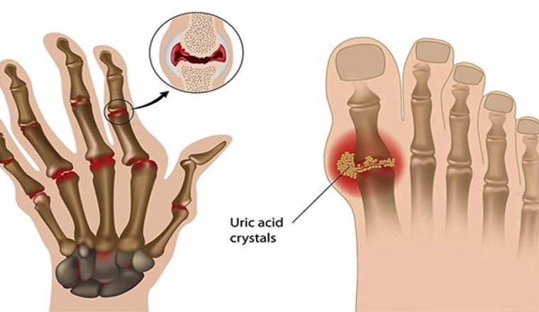 Diệp hạ châu và Râu mèo làm tăng hiệu quả hạ acid uric máu tốt nhất