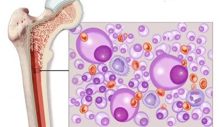 Nghiên cứu y khoa mới: Tìm ra phương pháp điều trị đa u tủy xương kháng thuốc