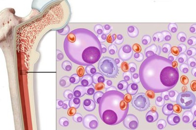 Nghiên cứu y khoa mới: Tìm ra phương pháp điều trị đa u tủy xương kháng thuốc