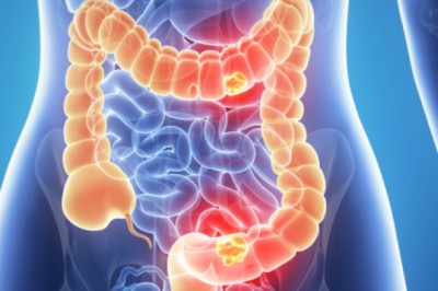 5 dấu hiệu sớm của bệnh ung thư ruột: Cảnh báo ca bệnh tăng gấp đôi ở người trẻ