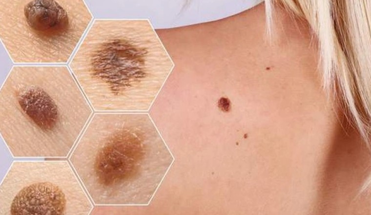 Cảnh báo các dấu hiệu sớm bệnh ung thư hắc tố tin mới nhất