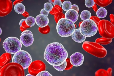 Bệnh bạch cầu là gì, dấu hiệu của bệnh bạch cầu