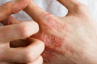 2 bộ phận trên cơ thể bị ngứa là dấu hiệu mắc bệnh tiểu đường