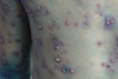 Món ăn là thuốc chữa bệnh thuỷ đậu giúp nhanh khỏi thuỷ đậu