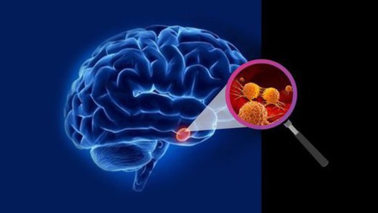 Dấu hiệu đầu tiên khi thức dậy vào buổi sáng báo hiệu khối u não
