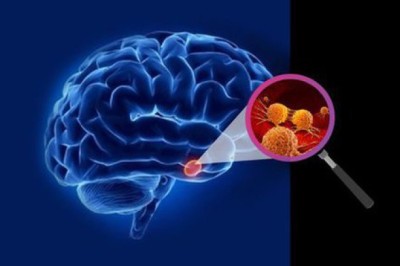 Dấu hiệu đầu tiên khi thức dậy vào buổi sáng báo hiệu khối u não