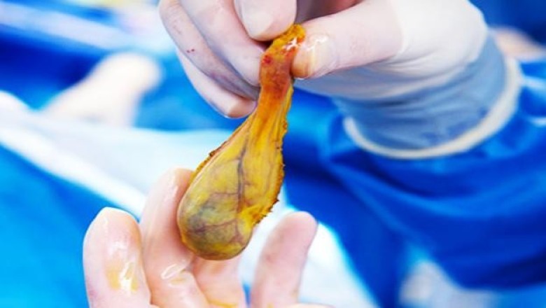 Bệnh Polyp túi mật là gì?