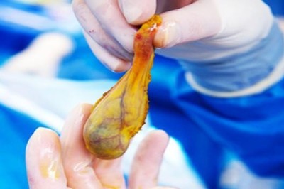 Bệnh Polyp túi mật là gì?