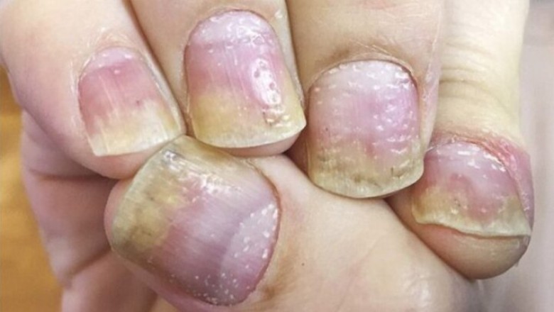 Móng tay bị rỗ là bệnh gì?
