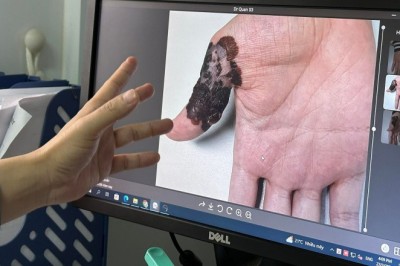 Dấu hiệu ung thư: Phát hiện ung thư da từ nốt ruồi trên bàn tay