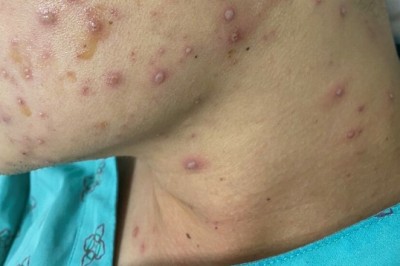 Bệnh thủy đậu lây lan ở nhiều trường học Hà Nội