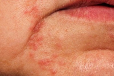 Dấu hiệu gan nhiễm mỡ trên khuôn mặt