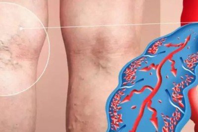 4 dấu hiệu cảnh báo cục máu đông trong cơ thể