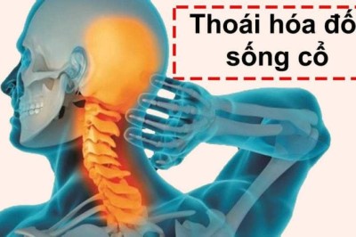 Các bài thuốc điều trị thoái hóa đốt sống cổ