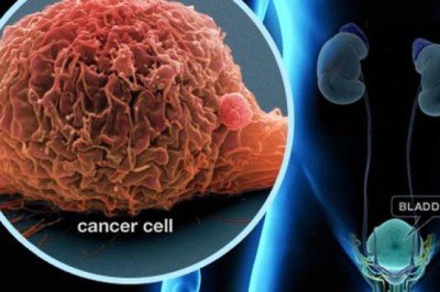 Dấu hiệu ung thư đường tiết niệu