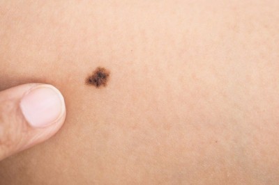 Trên người nếu thấy xuất hiện 3 vị trí có màu đen này hãy cẩn thận ung thư đang 'rình rập'