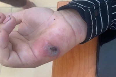 Điện Biên phát hiện 3 ổ dịch bệnh than trên người, Bộ Y tế vào cuộc