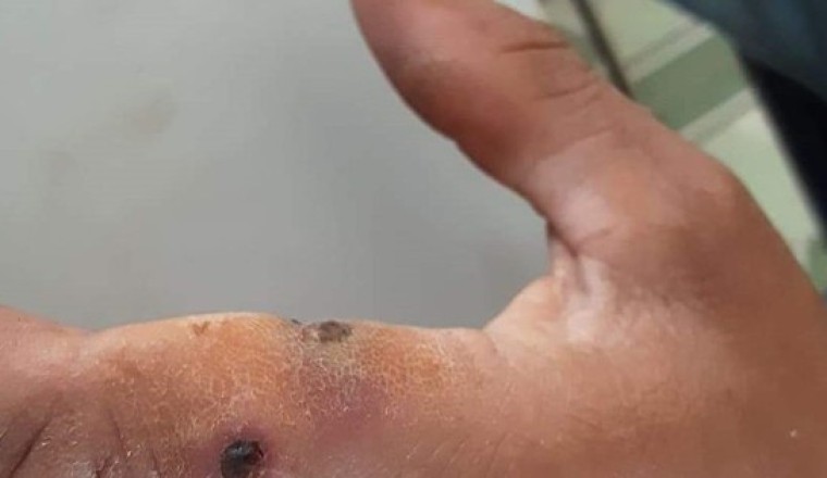 Nguy cơ bùng phát bệnh than, Lai Châu nghiêm cấm giết mổ, vận chuyển gia súc mắc bệnh chết