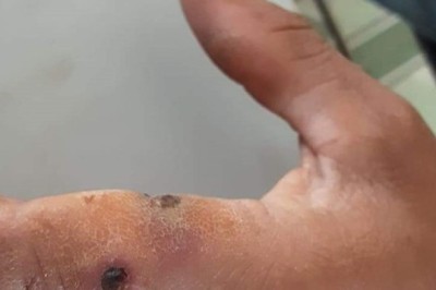 Nguy cơ bùng phát bệnh than, Lai Châu nghiêm cấm giết mổ, vận chuyển gia súc mắc bệnh chết