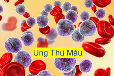 Bác sĩ cảnh báo những dấu hiệu ban đầu ung thư máu thường bị nhiều người bỏ qua